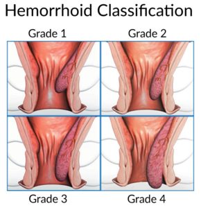 General information regarding endoscopic band ligation of haemorrhoids.